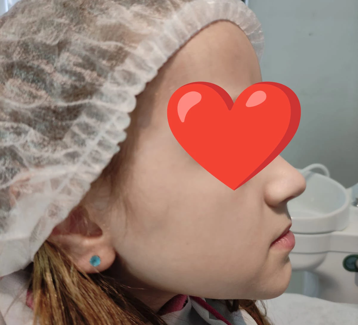Perfil antes del tratamiento de ortopedia